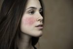 Beautiful young woman with rosacea